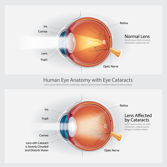 Cataracts diagram