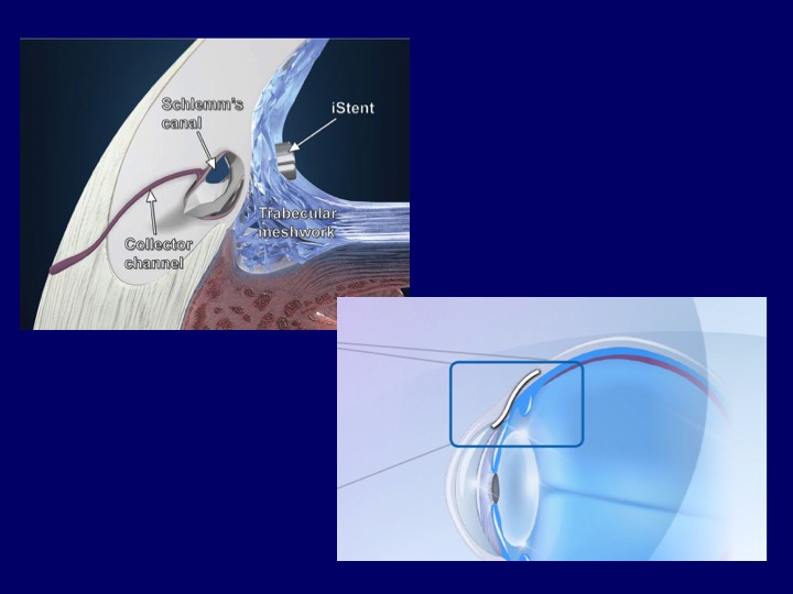 iStent Technology Diagram