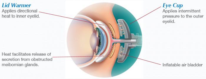 Dry Eye Treatment